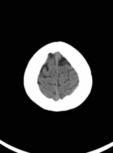 File:Cerebellar abscess (Radiopaedia 73727-84527 Axial non-contrast 60).jpg