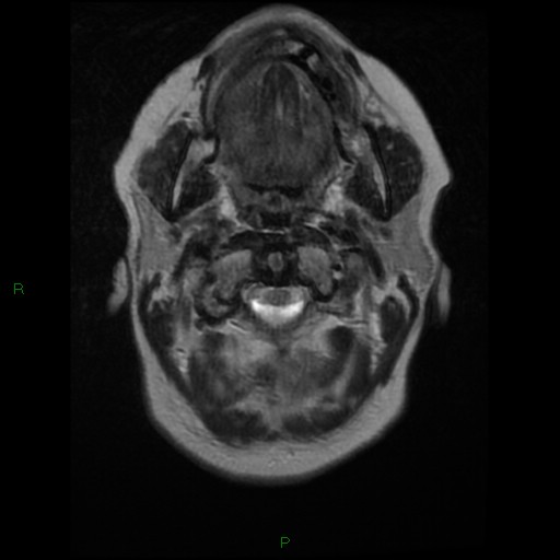File:Cerebellar abscess (Radiopaedia 78135-90678 Axial T2 1).jpg