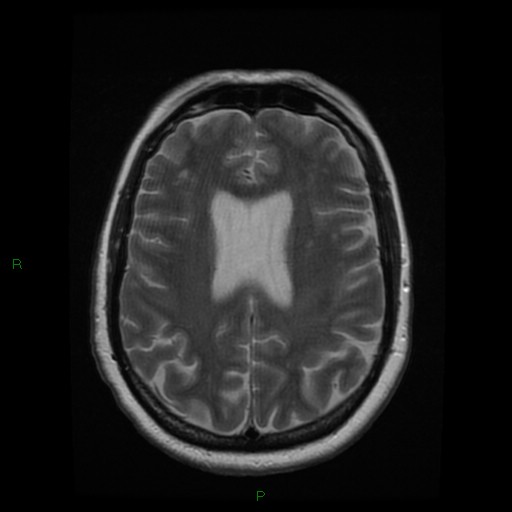 File:Cerebellar abscess (Radiopaedia 78135-90678 Axial T2 20).jpg