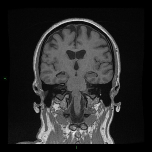 Cerebellar abscess (Radiopaedia 78135-90678 Coronal T1 C+ 87).jpg