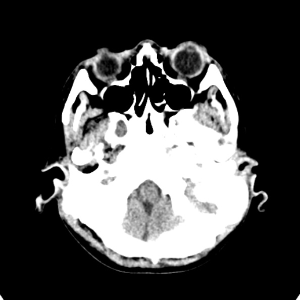 Cerebellar abscess secondary to mastoiditis (Radiopaedia 26284-26412 Axial non-contrast 20).jpg