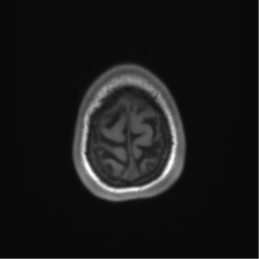 Cerebellar agenesis with hypoplastic pons (pontocerebellar hypoplasia) (Radiopaedia 57224-64138 Axial T1 71).png