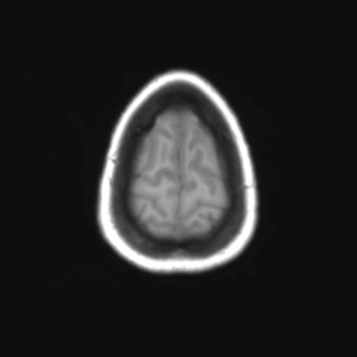 File:Cerebellar ependymoma complicated by post-operative subdural hematoma (Radiopaedia 83322-97736 Axial T1 36).png