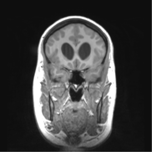 Cerebellar ependymoma complicated by post-operative subdural hematoma (Radiopaedia 83322-97736 Coronal T1 18).png