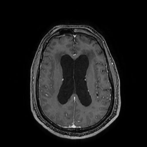 Cerebellar hemangioblastoma (Radiopaedia 88055-104622 Axial T1 C+ 110).jpg