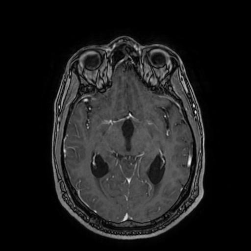 Cerebellar hemangioblastoma (Radiopaedia 88055-104622 Axial T1 C+ 87).jpg