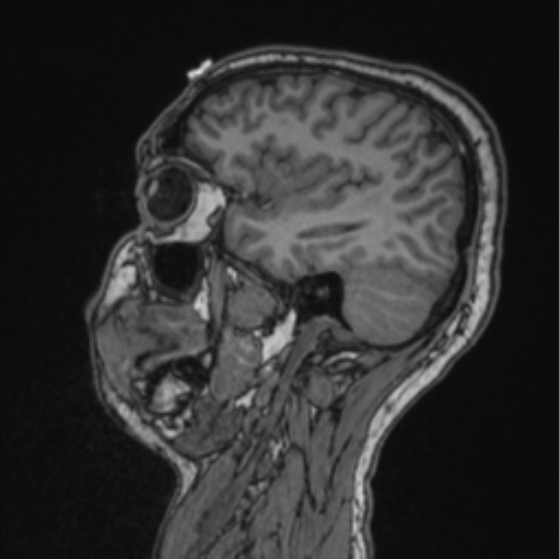 Cerebellar hemangioblastomas and pituitary adenoma (Radiopaedia 85490-101176 Sagittal T1 70).png