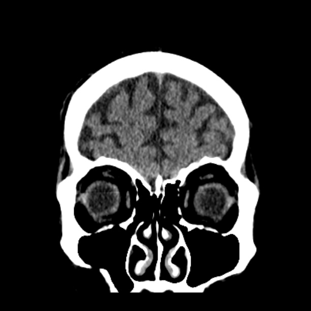Cerebellar hemorrhage (Radiopaedia 27193-27359 Coronal non-contrast 12).jpg
