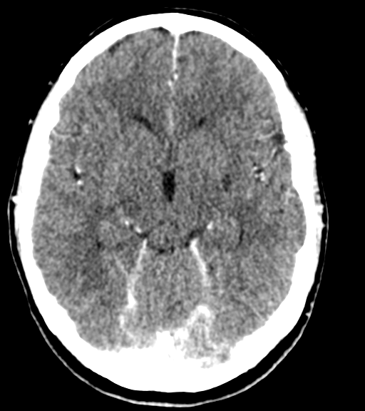 Cerebellar metastases - colorectal adenocarcinoma (Radiopaedia 40947-43652 Axial C+ 24).png