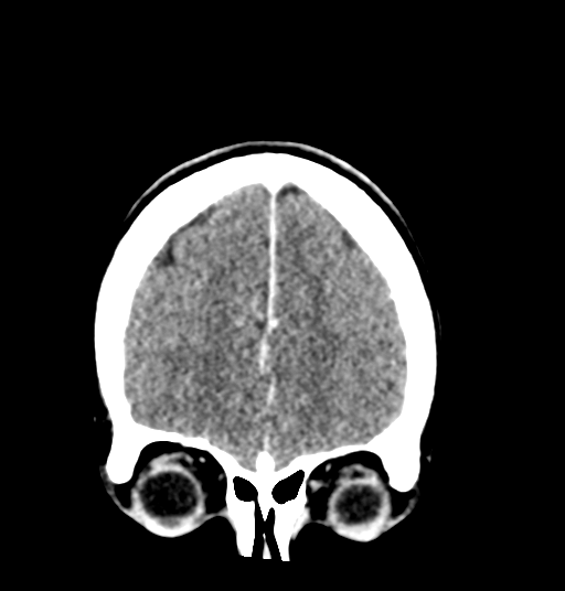 Cerebellar metastases - colorectal adenocarcinoma (Radiopaedia 40947-43652 Coronal C+ 20).png