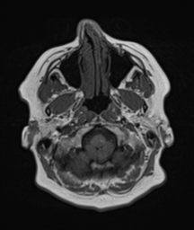 File:Cerebellar metastasis (Radiopaedia 54578-60810 Axial T1 4).png