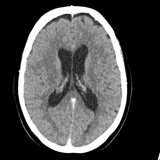 Cerebellar metastasis (Radiopaedia 54578-60812 Axial C+ 28).png