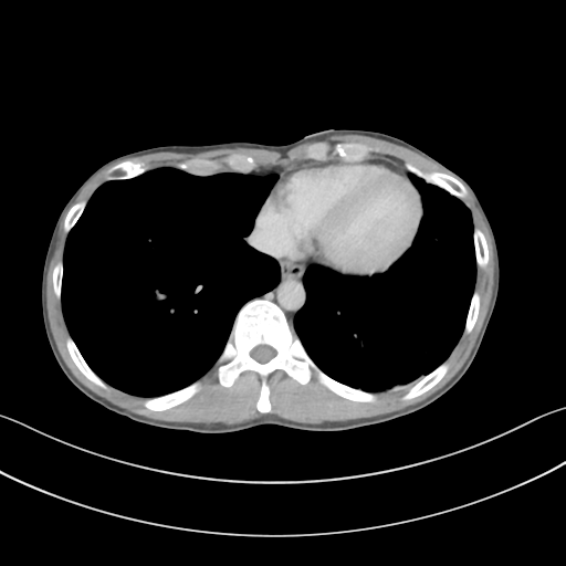 Cerebellar metastasis - adenocarcinoma lung (Radiopaedia 63184-71717 Axial C+ delayed 50).png