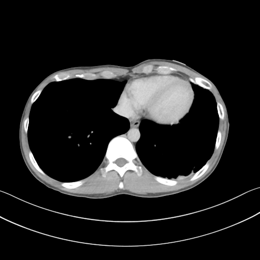 Cerebellar metastasis - adenocarcinoma lung (Radiopaedia 63184-71717 Axial C+ delayed 51).png