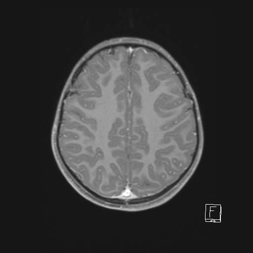 Cerebellar stroke (Radiopaedia 32202-33150 Axial T1 C+ 51).png