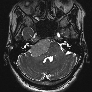 Cerebellopontine angle meningioma (Radiopaedia 72983-83680 Axial FIESTA 28).jpg