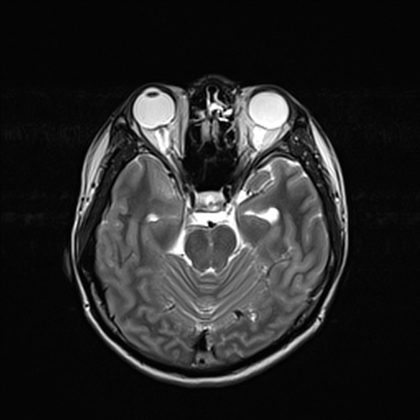 File:Cerebral abscess (Radiopaedia 24212-24478 Axial T2 24).jpg