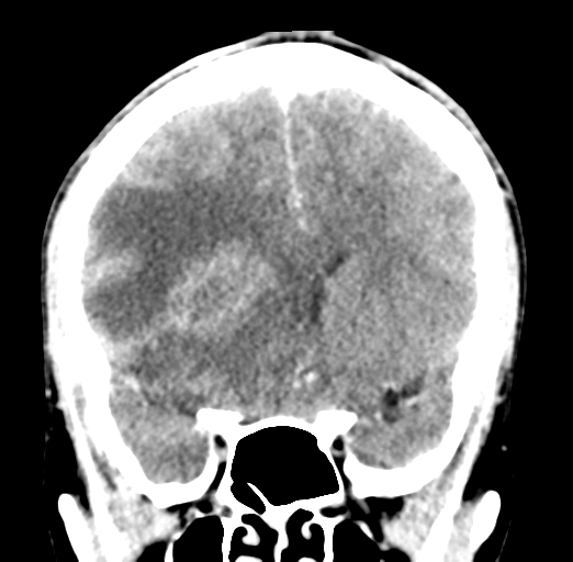 Cerebral abscess (Radiopaedia 60342-68008 Coronal C+ delayed 25).png