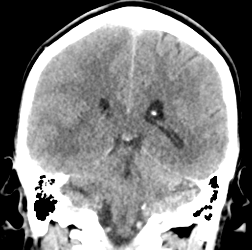 Cerebral abscess (Radiopaedia 60342-68008 Coronal non-contrast 41).png