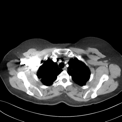 File:Cerebral abscess from pulmonary arteriovenous malformation (Radiopaedia 86275-102292 A 13).png