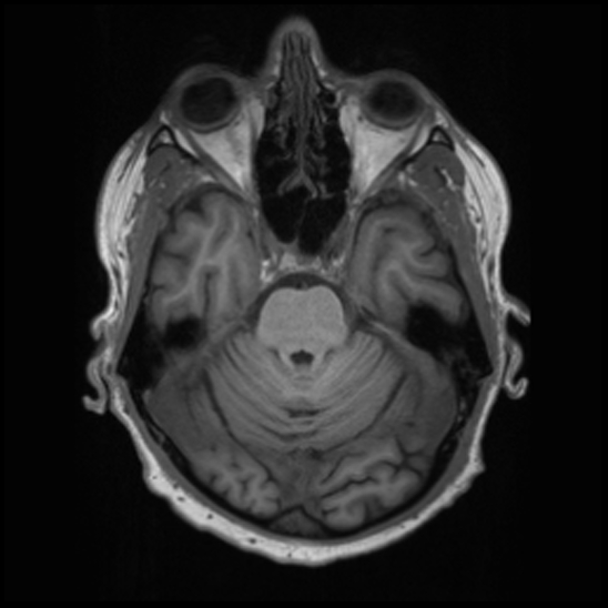 File:Cerebral abscess with ventriculitis (Radiopaedia 78965-91878 Axial T1 15).jpg