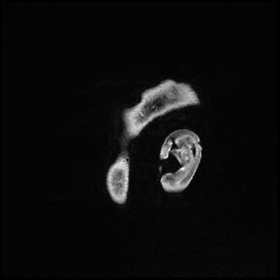 Cerebral abscess with ventriculitis (Radiopaedia 78965-91878 Sagittal T1 C+ 4).jpg