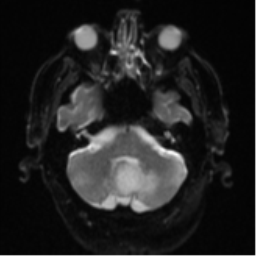 Cerebral abscesses- medically managed (Radiopaedia 45183-49179 Axial DWI 7).png