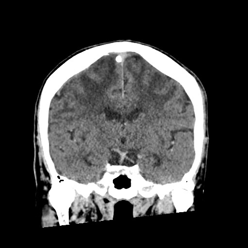 Cerebral amyloid angiopathy-related inflammation (Radiopaedia 74836-85848 Coronal non-contrast 36).jpg