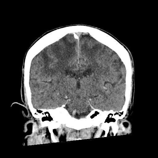 Cerebral amyloid angiopathy-related inflammation (Radiopaedia 74836-85848 Coronal non-contrast 40).jpg