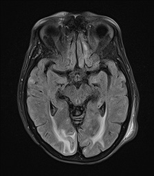File:Cerebral amyloid angiopathy-related inflammation (Radiopaedia 74836-85849 Axial FLAIR 13).jpg