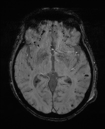 Cerebral amyloid angiopathy-related inflammation (Radiopaedia 74836-85849 Axial SWI 35).jpg