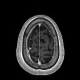Cerebral amyloid angiopathy (Radiopaedia 29129-29518 Axial T1 C+ 132).jpg