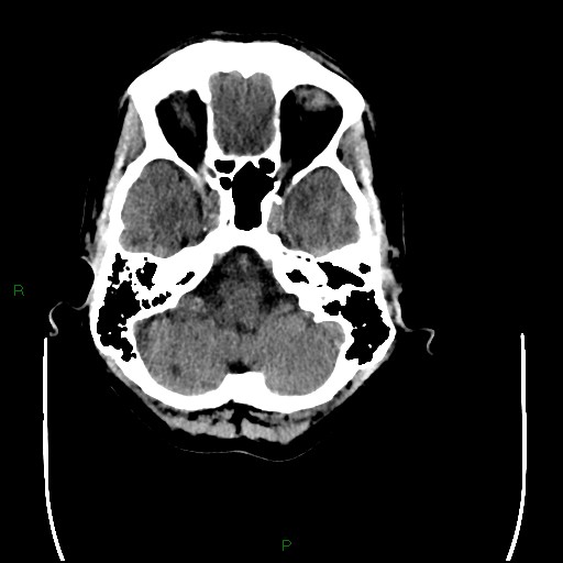 File:Cerebral amyloid angiopathy (Radiopaedia 77506-89665 Axial non-contrast 22).jpg