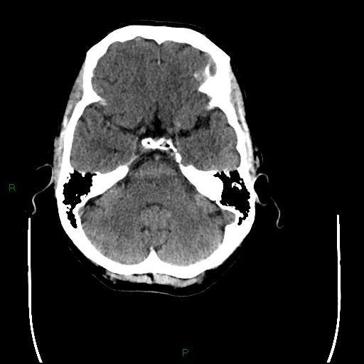 Cerebral amyloid angiopathy (Radiopaedia 77506-89665 Axial non-contrast 29).jpg