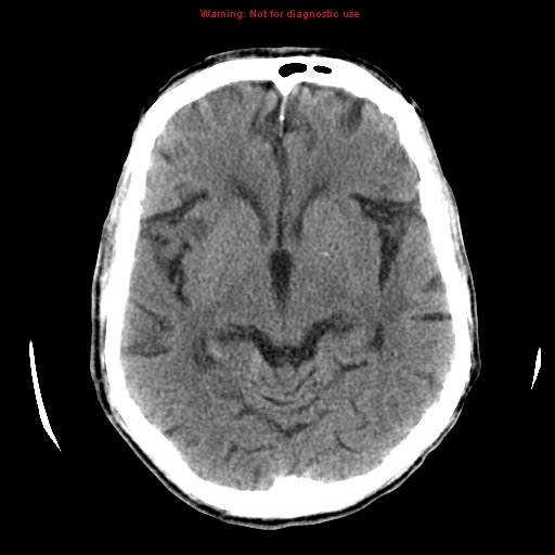 File:Cerebral and orbital tuberculomas (Radiopaedia 13308-13310 Axial non-contrast 13).jpg