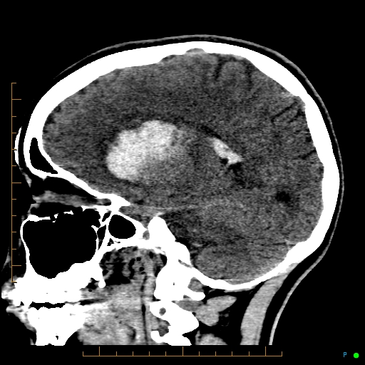 Cerebral arteriovenous malformation (AVM) (Radiopaedia 78162-90706 A 32).jpg