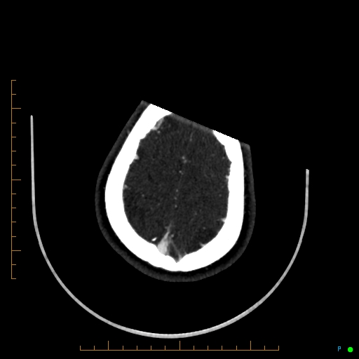 Cerebral arteriovenous malformation (AVM) (Radiopaedia 78162-90706 Axial CTA 238).jpg