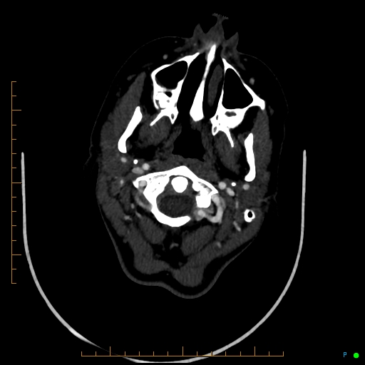 Cerebral arteriovenous malformation (AVM) (Radiopaedia 78162-90706 Axial CTA 33).jpg