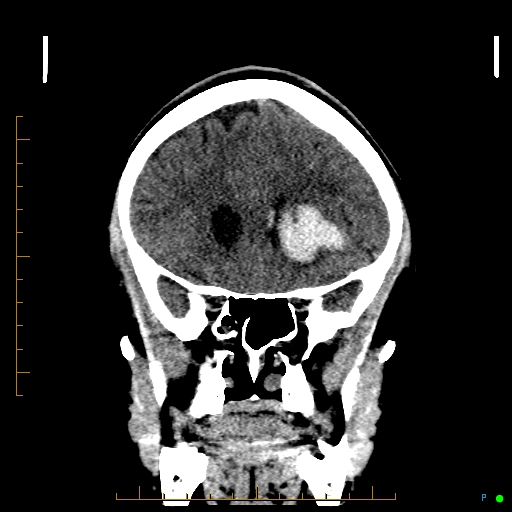 Cerebral arteriovenous malformation (AVM) (Radiopaedia 78162-90706 Coronal non-contrast 33).jpg