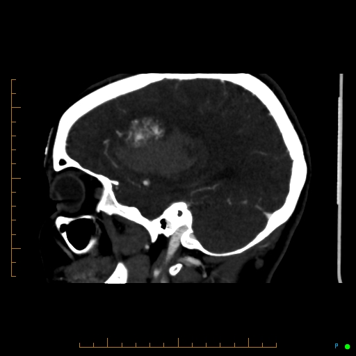 Cerebral arteriovenous malformation (AVM) (Radiopaedia 78162-90706 Sagittal CTA 25).jpg