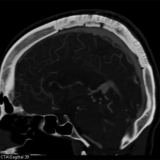 Cerebral arteriovenous malformation (Radiopaedia 28518-28759 D 36).jpg