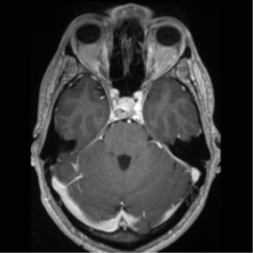 Cerebral arteriovenous malformation (Radiopaedia 55798-62372 Axial T1 C+ 23).png