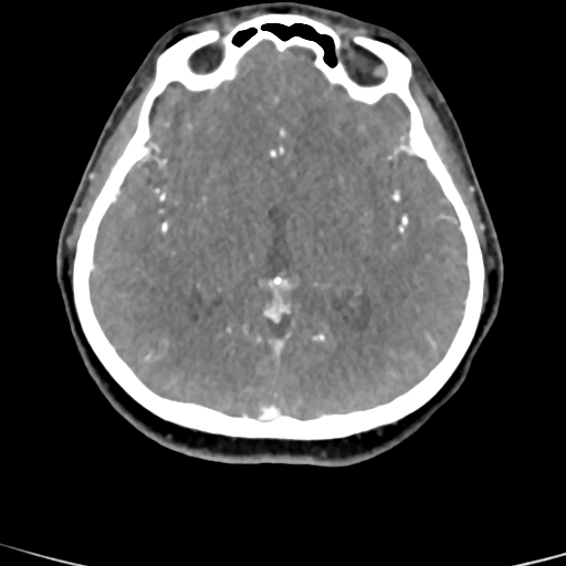 Cerebral arteriovenous malformation (Radiopaedia 73830-84645 B 52).jpg