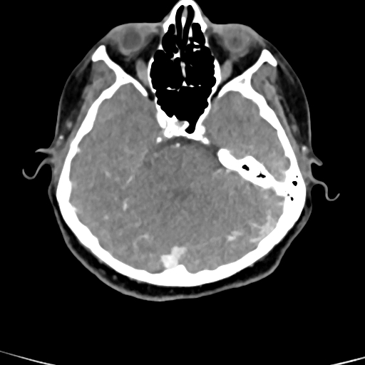 File:Cerebral arteriovenous malformation (Radiopaedia 73830-84645 B 70).jpg
