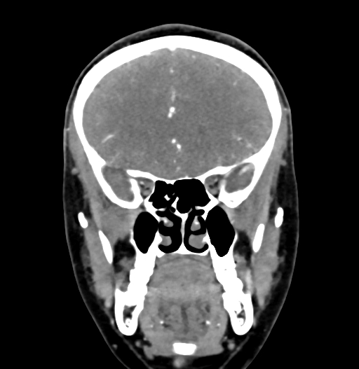 Cerebral arteriovenous malformation (Radiopaedia 73830-84645 C 31).jpg