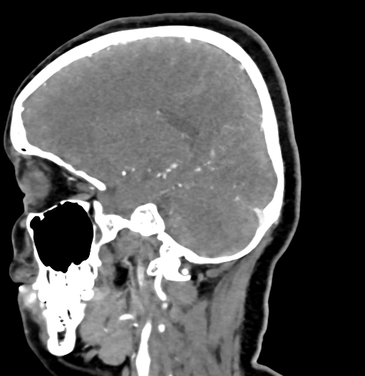 Cerebral arteriovenous malformation (Radiopaedia 73830-84645 D 35).jpg