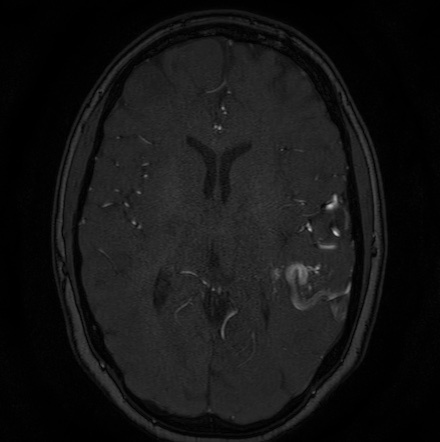 Cerebral arteriovenous malformation (Radiopaedia 74411-85654 Axial MRA 79).jpg