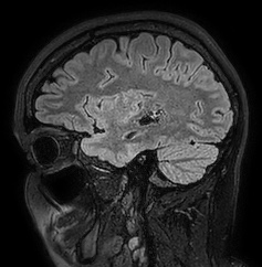 Cerebral arteriovenous malformation (Radiopaedia 74411-85654 Sagittal FLAIR 32).jpg