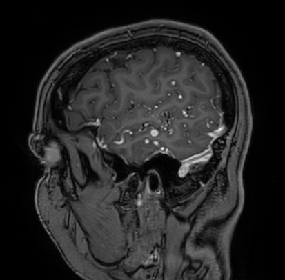 Cerebral arteriovenous malformation (Radiopaedia 74411-85654 Sagittal T1 C+ 17).jpg