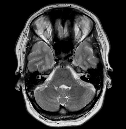 File:Cerebral arteriovenous malformation (Radiopaedia 74411-85745 Axial T2 7).jpg